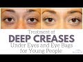 Treatment for Young People with Eye Bags and Deep Creases Under Eyes