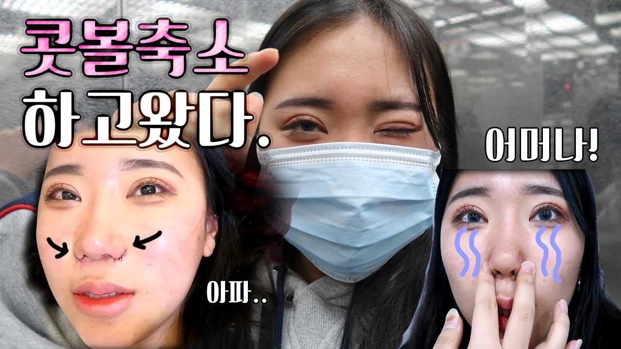 평생 고민이었던 콧볼축소 수술후기❗ㅣ하나하나 다 알아봤음👏ㅣ전후비교🙆🏻ㅣ자매
