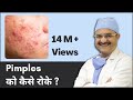 Pimples को कैसे रोके (How to Prevent Pimples) | ClearSkin, Pune | (In HINDI)