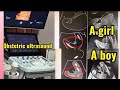 Finding baby boy and girl of obstetric ultrasound #girl #boy #ultrasound #obstetricsandgynecology