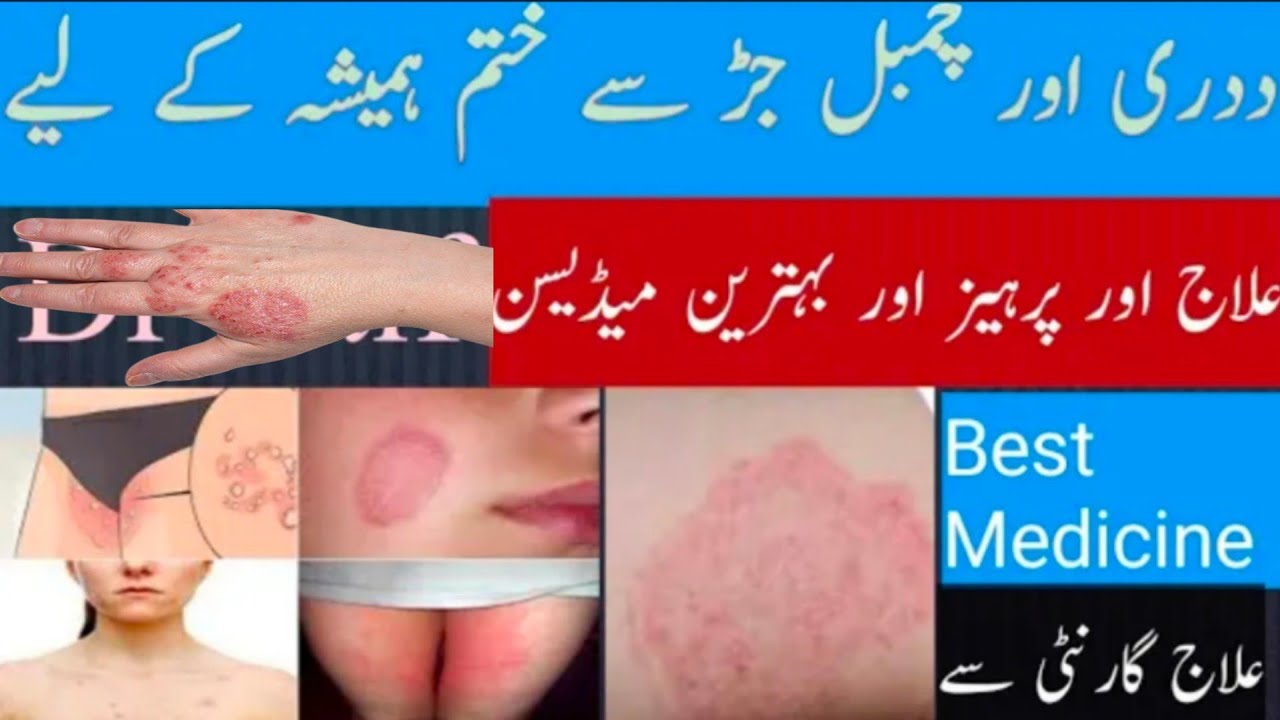 Fungal RingwormTreatmentFungal infection permanent treatment Daadka