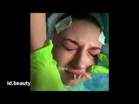 💋Тредлифтинг губ👄