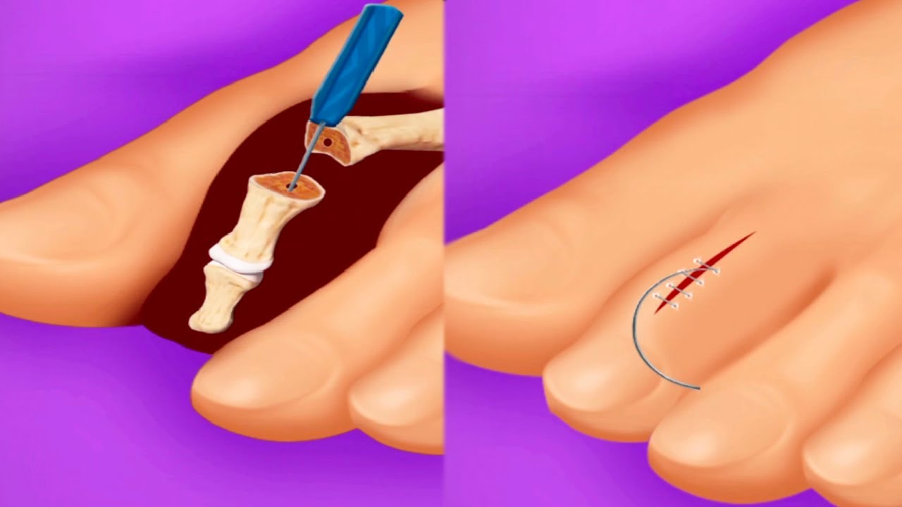 ASMR Foot Finger Surgery Bone Surgery Foot Finger Treatment