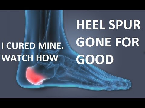 How to get rid of heel spur fast - YouTube