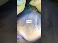 liceinfestation710 #headliceremoval #licecomb #headlice #headlicetreatment #hairlice #haircare #hair
