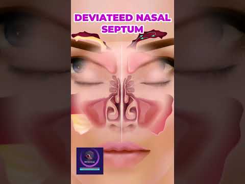 The Nasal Septum Why It Matters For Your Breathing