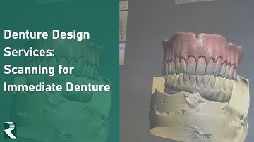 Denture Design Services for In-Office Fabrication: Scanning for Immediate Denture