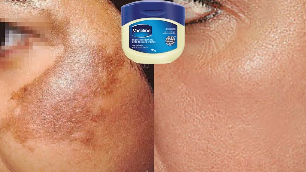 How To Use Vaseline To Treat Pigmentation, Dark Spots & Acne Scars
