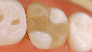 Upper 7 ((Complex cavity , composite filling restoration))