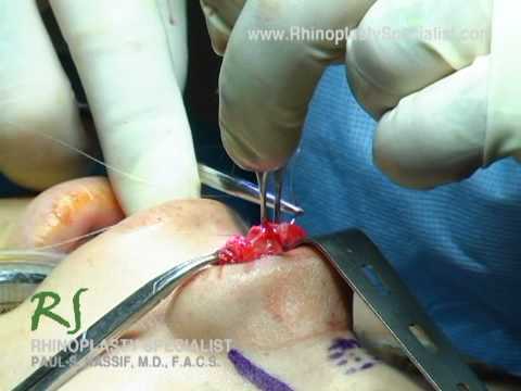 Video thumbnail: Dr. Paul Nassif Performs Nose Job Live · NassifMD®