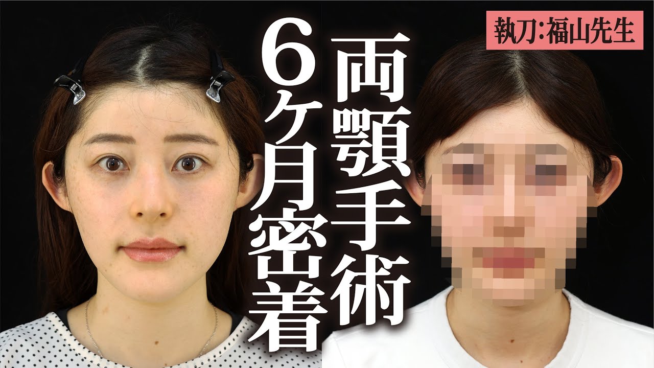 【密着】他院で行った両顎手術の修正に密着しました