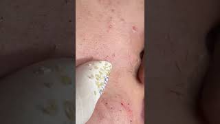 #TextBlackheads Removal  #Text Relax | satisfying   With Din Spa 2025 🏆 😆 😿