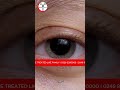 3 Hidden Causes of Burning Eyes | Eye Care Tips | #eyecare #eyehealth