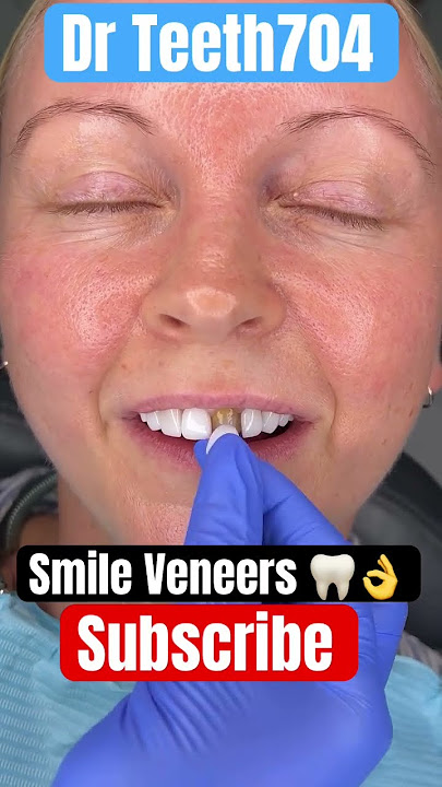 Smile Veneers π¦·π¦·ππ#shortvideo ππππ¦·π¦·#youtubeshorts ππ¦·π