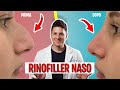 Rinofiller   correggere il naso senza chirurgia  dott claudio maestrini