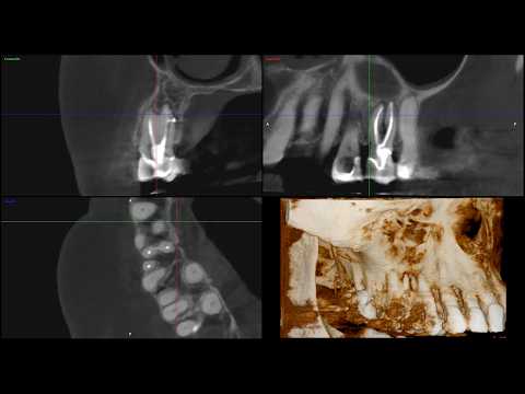 Rare find Maxillary second premolar with three roots