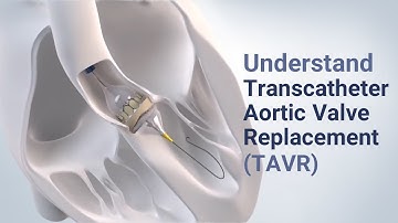 Understand Transcatheter Aortic Valve Replacement (TAVR) - See the Procedure