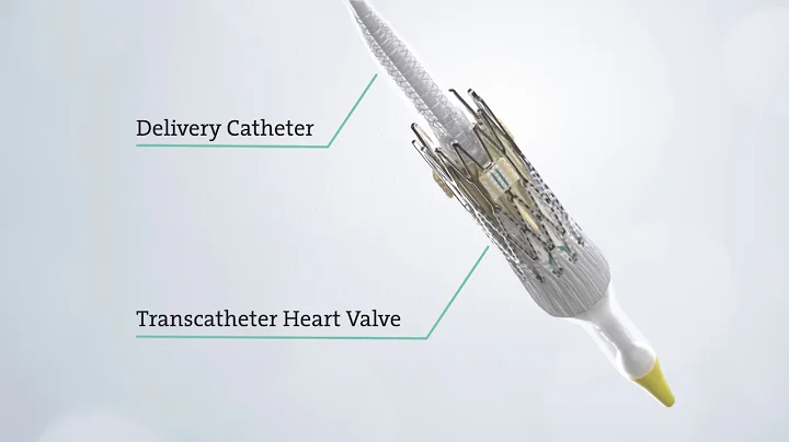 Transcatheter Aortic Valve Replacement (TAVR) - See the Procedure - DayDayNews