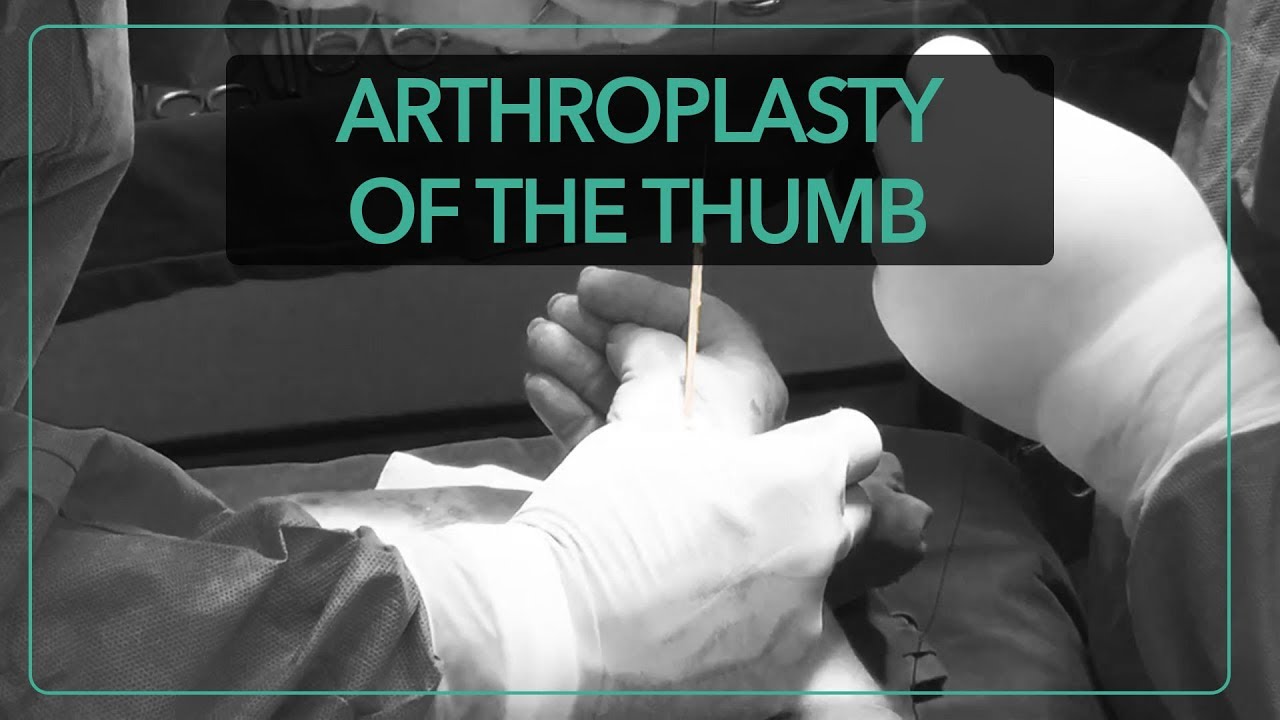 Cyprus Hand Surgery | Arthroplasty of the Thumb by Dr. Andreas ...