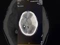 Meningioma on Brain CT | Key Imaging Signs #shorts