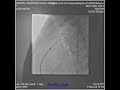 Sidratul Muntarin Shafa 4 Y 13Kg PDA device closure done