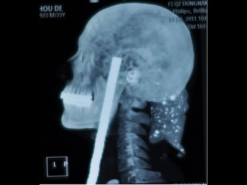 Vücutlarına Cisim Saplanan İnsanların Enterasan Röntgen Görüntüleri