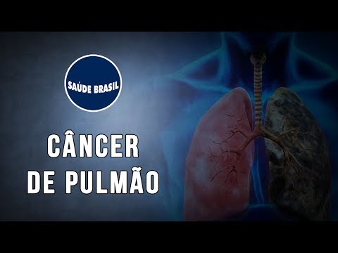 Vídeo: Câncer De Células Escamosas Do Pulmão: Como Curar. Câncer De Células Escamosas Do Pulmão: Sintomas E Prognóstico