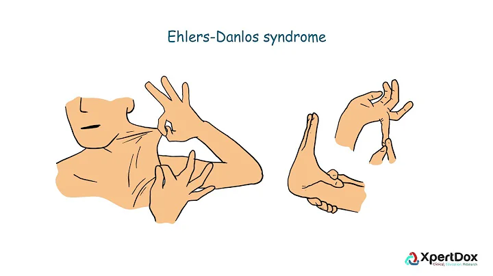 What is Ehlers Danlos Syndrome?