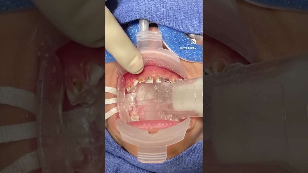 The most comfortable retractor | Zyris Hoopla Retractor #dentist #dentalhygiene #pediatricdentistry