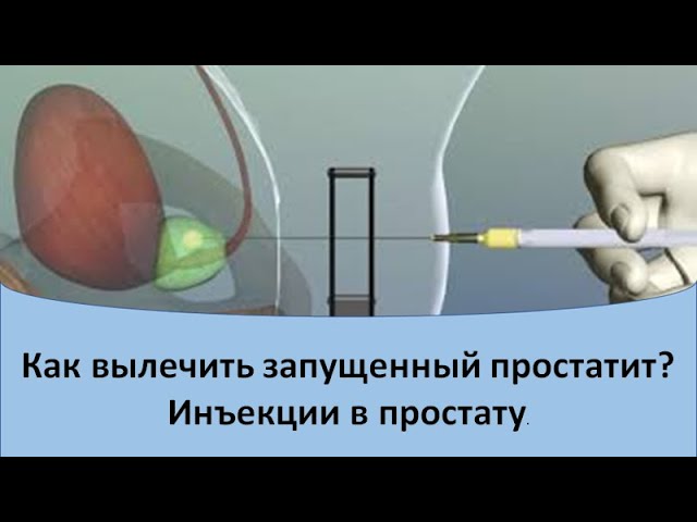 Лечение простатита. Инъекции в простату