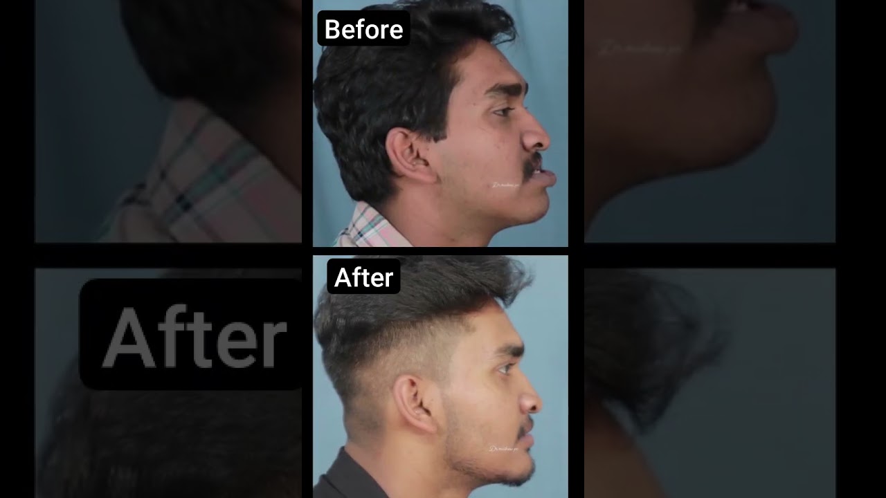 Jaw Surgery Before & After | Facial Symmetry & Bite Correction by Dr. Mathew PC 