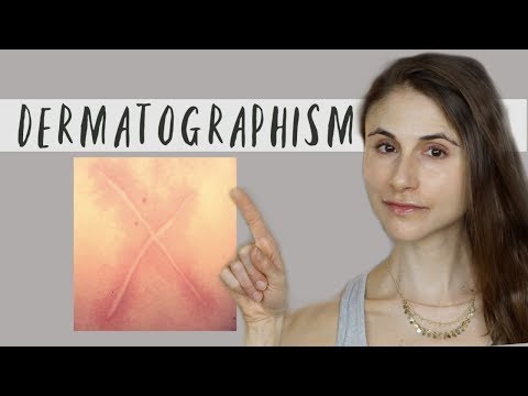 Video: Dermographism - Signs, Treatment, Causes, Forms, Diagnosis