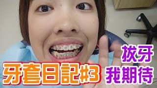 牙套日記#3 拔牙啦！正妹是值得你等待的～｜移動岑寶