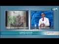 اهم 3 أمراض لعظام الأطفال و طريقة العلاج مع الدكتور إبراهيم حنتيرة اهم 3 أمراض لعظام الأطفال و طريقة العلاج مع الدكتور إبراهيم حنتيرة