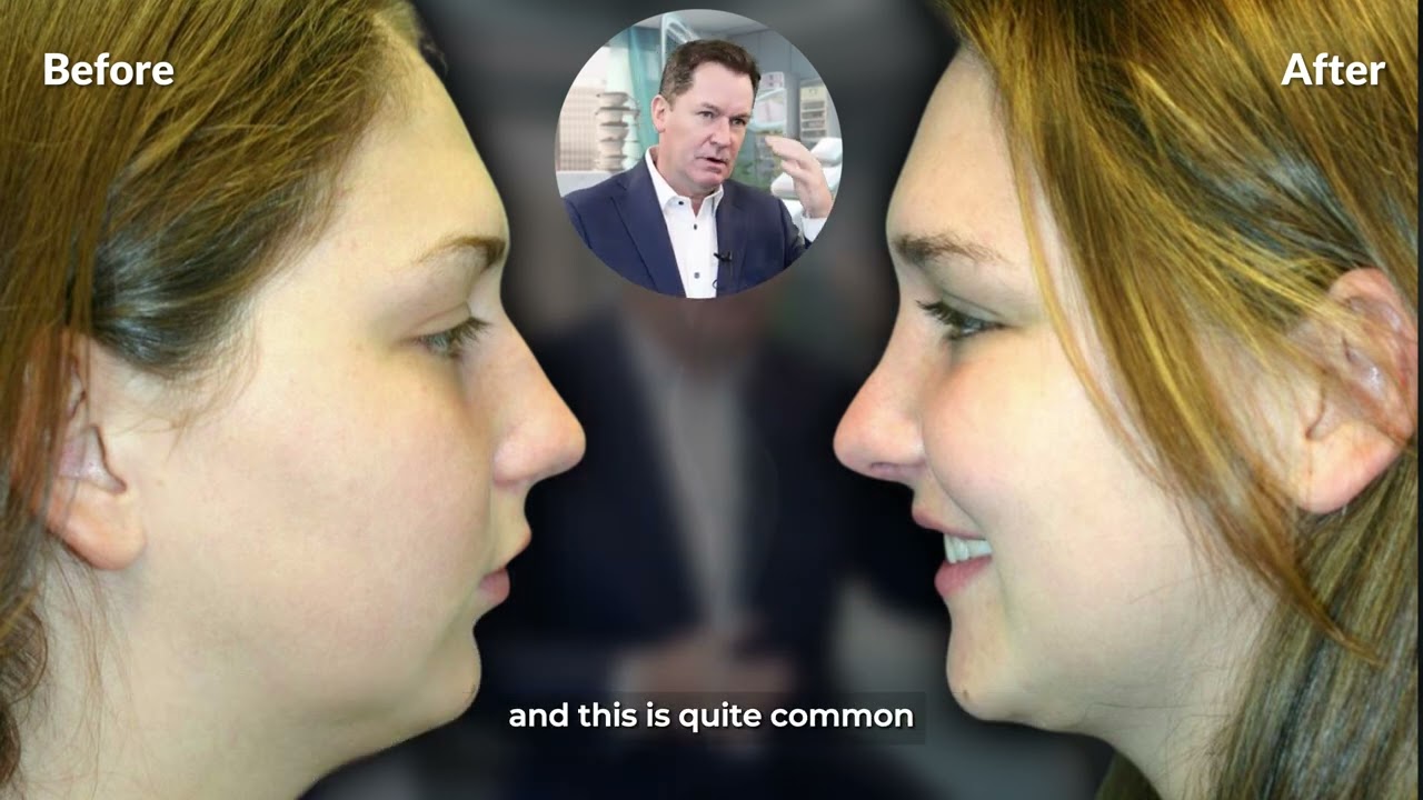 Rhinoplasty & chin augmentation, 20 years old