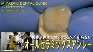 (naoki)セラミックオーバーレイ治療とラバーダムテクニック naoki)セラミックオーバーレイ治療とラバーダムテクニック naoki