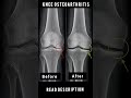 #kneepain #painfreelife #pain #physiotherapy #physiotherapist #physio #short #viral #fypシ゚viral #fyp
