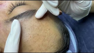 Acne Pimple Popping Blackhead removal - Blemish Extraction Treatment - Health &amp; Beauty