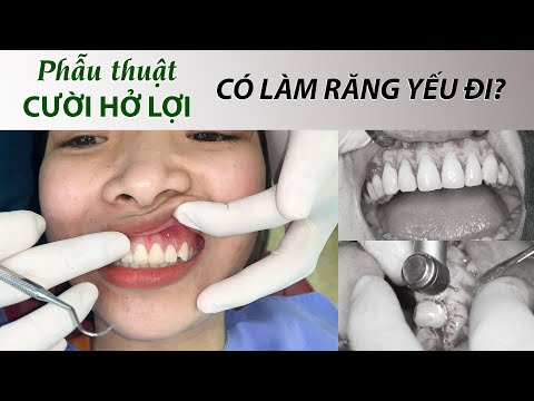 chăm sóc răng sau khi lấy cao răng tại Kemtrinam.vn