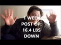 Gastric Sleeve (VSG) - 1 Week Post-Op - Back to Work