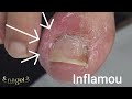 😱 PROCESSO INFLAMATÓRIO NA LATERAL DA UNHA #satisfying #nails