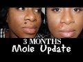 Three Months Mole Removal Update|So Trudee