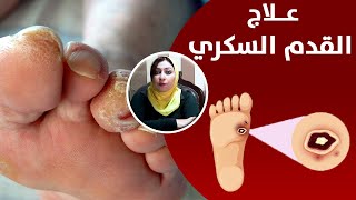 طرق علاج قرحة القدم السكرى و كيفية الوقاية منها