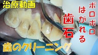 ボロボロとれる歯石取り。歯のクリーニング動画。 Teeth Cleaning Removing Tartar