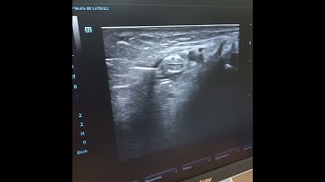 Tibial nerve hydrodissection