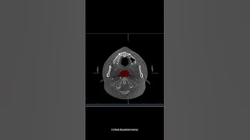 Create 3D airway via Invivo7