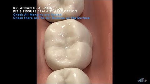 Pit and fissure sealant application - Arabic عربي