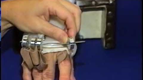 I - Dynamic Extension Splint for Metacarpophalangeal Joints Part 2