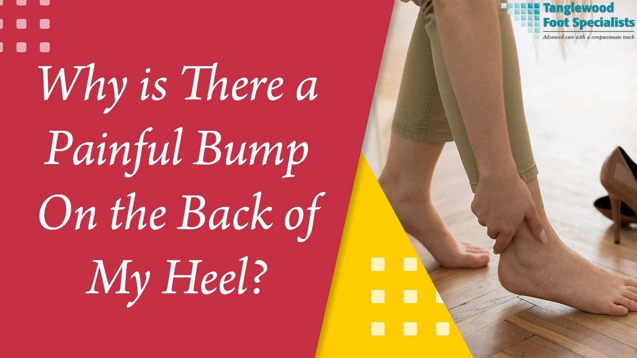 Dr Steven Kent - Orthopaedic Foot, Ankle & Trauma Surgeon - Do you suffer  from pain at the back of the heel? Do you get pain below the calf when you  go