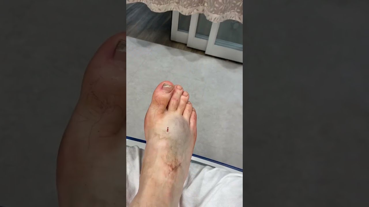 Poor Mathew Youtubeshorts Dirtbike Crash Shortsvideo Bike Hospital Motorcycle